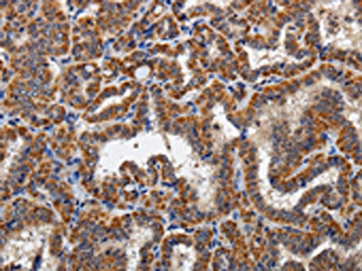 The image on the left is immunohistochemistry of paraffin-embedded Human thyroid cancer tissue using CSB-PA900886(KLK6 Antibody) at dilution 1/60, on the right is treated with fusion protein. (Original magnification: ×200)