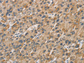 The image on the left is immunohistochemistry of paraffin-embedded Human liver cancer tissue using CSB-PA900926(DDIT4L Antibody) at dilution 1/20, on the right is treated with fusion protein. (Original magnification: ×200)