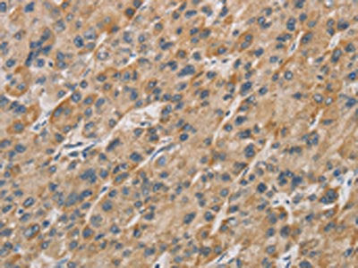 The image on the left is immunohistochemistry of paraffin-embedded Human liver cancer tissue using CSB-PA900926(DDIT4L Antibody) at dilution 1/20, on the right is treated with fusion protein. (Original magnification: ×200)