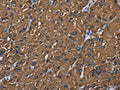The image on the left is immunohistochemistry of paraffin-embedded Human liver cancer tissue using CSB-PA901137(BMP3 Antibody) at dilution 1/20, on the right is treated with synthetic peptide. (Original magnification: ×200)