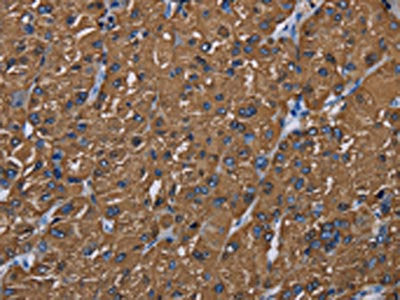 The image on the left is immunohistochemistry of paraffin-embedded Human liver cancer tissue using CSB-PA901137(BMP3 Antibody) at dilution 1/20, on the right is treated with synthetic peptide. (Original magnification: ×200)