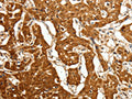 The image on the left is immunohistochemistry of paraffin-embedded Human lung cancer tissue using CSB-PA901428(CDH23 Antibody) at dilution 1/80, on the right is treated with fusion protein. (Original magnification: ×200)