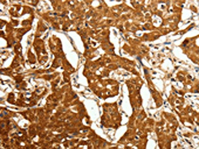 The image on the left is immunohistochemistry of paraffin-embedded Human lung cancer tissue using CSB-PA901428(CDH23 Antibody) at dilution 1/80, on the right is treated with fusion protein. (Original magnification: ×200)