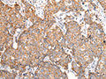 The image on the left is immunohistochemistry of paraffin-embedded Human breast cancer tissue using CSB-PA901585(ADAMTS1 Antibody) at dilution 1/30, on the right is treated with synthetic peptide. (Original magnification: ×200)