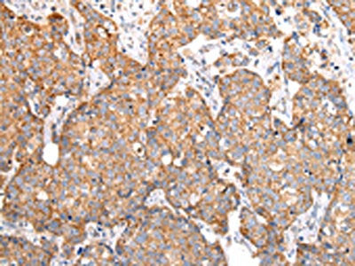 The image on the left is immunohistochemistry of paraffin-embedded Human breast cancer tissue using CSB-PA901585(ADAMTS1 Antibody) at dilution 1/30, on the right is treated with synthetic peptide. (Original magnification: ×200)