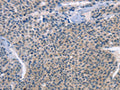 The image on the left is immunohistochemistry of paraffin-embedded Human liver cancer tissue using CSB-PA902150(LRRK2 Antibody) at dilution 1/30, on the right is treated with fusion protein. (Original magnification: ×200)