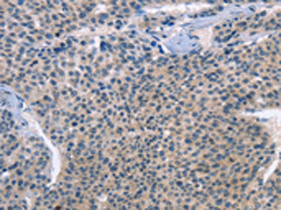 The image on the left is immunohistochemistry of paraffin-embedded Human liver cancer tissue using CSB-PA902150(LRRK2 Antibody) at dilution 1/30, on the right is treated with fusion protein. (Original magnification: ×200)