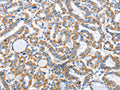 The image on the left is immunohistochemistry of paraffin-embedded Human thyroid cancer tissue using CSB-PA902603(ARL11 Antibody) at dilution 1/30, on the right is treated with fusion protein. (Original magnification: ×200)