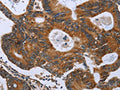 The image on the left is immunohistochemistry of paraffin-embedded Human colon cancer tissue using CSB-PA902740(GH2 Antibody) at dilution 1/40, on the right is treated with fusion protein. (Original magnification: ×200)
