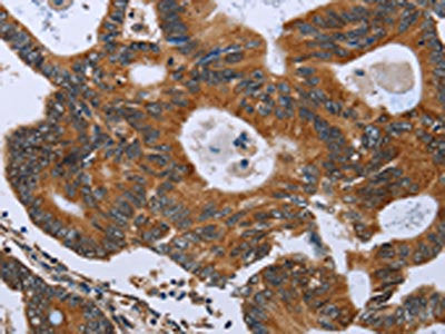 The image on the left is immunohistochemistry of paraffin-embedded Human colon cancer tissue using CSB-PA902740(GH2 Antibody) at dilution 1/40, on the right is treated with fusion protein. (Original magnification: ×200)