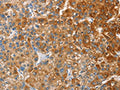 The image on the left is immunohistochemistry of paraffin-embedded Human liver cancer tissue using CSB-PA903031(CD200R1 Antibody) at dilution 1/60, on the right is treated with fusion protein. (Original magnification: ×200)