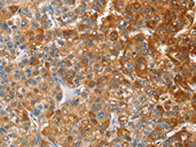 The image on the left is immunohistochemistry of paraffin-embedded Human liver cancer tissue using CSB-PA903031(CD200R1 Antibody) at dilution 1/60, on the right is treated with fusion protein. (Original magnification: ×200)