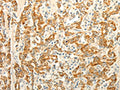 The image on the left is immunohistochemistry of paraffin-embedded Human gastic cancer tissue using CSB-PA903141(ERG Antibody) at dilution 1/30, on the right is treated with fusion protein. (Original magnification: ×200)