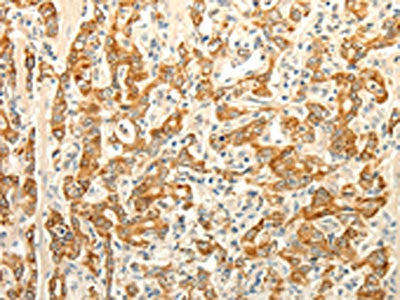The image on the left is immunohistochemistry of paraffin-embedded Human gastic cancer tissue using CSB-PA903141(ERG Antibody) at dilution 1/30, on the right is treated with fusion protein. (Original magnification: ×200)