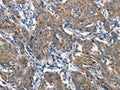 The image on the left is immunohistochemistry of paraffin-embedded Human gastic cancer tissue using CSB-PA903339(CHMP1A Antibody) at dilution 1/60, on the right is treated with fusion protein. (Original magnification: ×200)