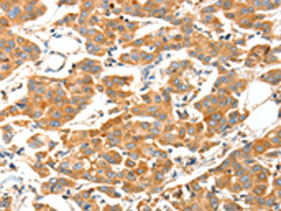 The image on the left is immunohistochemistry of paraffin-embedded Human breast cancer tissue using CSB-PA903364(ADAMTS18 Antibody) at dilution 1/30, on the right is treated with fusion protein. (Original magnification: ×200)