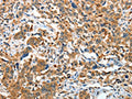 The image on the left is immunohistochemistry of paraffin-embedded Human esophagus cancer tissue using CSB-PA903370(IL22RA1 Antibody) at dilution 1/20, on the right is treated with fusion protein. (Original magnification: ×200)