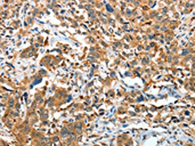 The image on the left is immunohistochemistry of paraffin-embedded Human esophagus cancer tissue using CSB-PA903370(IL22RA1 Antibody) at dilution 1/20, on the right is treated with fusion protein. (Original magnification: ×200)