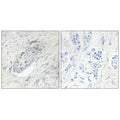 Immunohistochemistry analysis of paraffin-embedded human breast carcinoma tissue, using ZNF232 antibody.