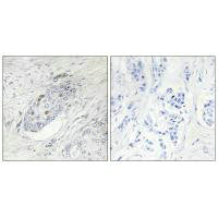 Immunohistochemistry analysis of paraffin-embedded human breast carcinoma tissue, using ZNF232 antibody.