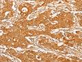 The image on the left is immunohistochemistry of paraffin-embedded Human gastic cancer tissue using CSB-PA903762(YARS2 Antibody) at dilution 1/20, on the right is treated with fusion protein. (Original magnification: ×200)