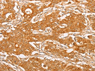 The image on the left is immunohistochemistry of paraffin-embedded Human gastic cancer tissue using CSB-PA903762(YARS2 Antibody) at dilution 1/20, on the right is treated with fusion protein. (Original magnification: ×200)