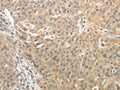 The image on the left is immunohistochemistry of paraffin-embedded Human ovarian cancer tissue using CSB-PA903853(TH Antibody) at dilution 1/10, on the right is treated with synthetic peptide. (Original magnification: ×200)