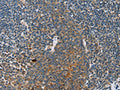 The image on the left is immunohistochemistry of paraffin-embedded Human tonsil tissue using CSB-PA903855(INHBA Antibody) at dilution 1/30, on the right is treated with fusion protein. (Original magnification: ×200)