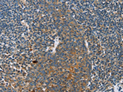 The image on the left is immunohistochemistry of paraffin-embedded Human tonsil tissue using CSB-PA903855(INHBA Antibody) at dilution 1/30, on the right is treated with fusion protein. (Original magnification: ×200)
