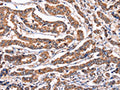 The image on the left is immunohistochemistry of paraffin-embedded Human breast cancer tissue using CSB-PA903914(PPIF Antibody) at dilution 1/60, on the right is treated with fusion protein. (Original magnification: ×200)