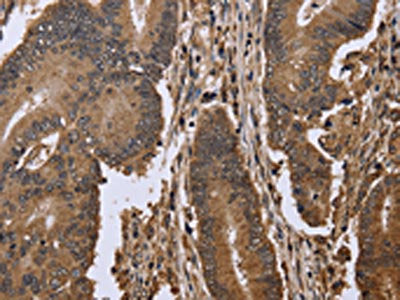The image on the left is immunohistochemistry of paraffin-embedded Human colon cancer tissue using CSB-PA903985(EIF3H Antibody) at dilution 1/50, on the right is treated with fusion protein. (Original magnification: ×200)