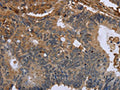 The image on the left is immunohistochemistry of paraffin-embedded Human colon cancer tissue using CSB-PA904028(FLNA Antibody) at dilution 1/50, on the right is treated with fusion protein. (Original magnification: ×200)