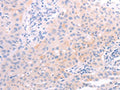 The image on the left is immunohistochemistry of paraffin-embedded Human lung cancer tissue using CSB-PA904437(AMH Antibody) at dilution 1/30, on the right is treated with synthetic peptide. (Original magnification: ×200)