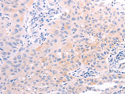 The image on the left is immunohistochemistry of paraffin-embedded Human lung cancer tissue using CSB-PA904437(AMH Antibody) at dilution 1/30, on the right is treated with synthetic peptide. (Original magnification: ×200)