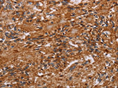 The image on the left is immunohistochemistry of paraffin-embedded Human ovarian cancer tissue using CSB-PA904679(JAKMIP2 Antibody) at dilution 1/40, on the right is treated with fusion protein. (Original magnification: ×200)