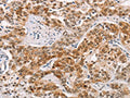 The image on the left is immunohistochemistry of paraffin-embedded Human prostate cancer tissue using CSB-PA904720(CABLES1 Antibody) at dilution 1/15, on the right is treated with fusion protein. (Original magnification: ×200)