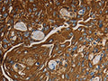 The image on the left is immunohistochemistry of paraffin-embedded Human esophagus cancer tissue using CSB-PA904747(NRP1 Antibody) at dilution 1/25, on the right is treated with fusion protein. (Original magnification: ×200)