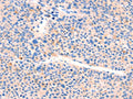The image on the left is immunohistochemistry of paraffin-embedded Human liver cancer tissue using CSB-PA904906(AIMP2 Antibody) at dilution 1/25, on the right is treated with synthetic peptide. (Original magnification: ×200)