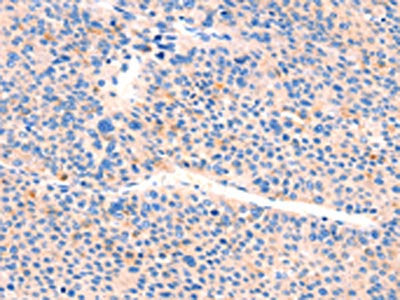 The image on the left is immunohistochemistry of paraffin-embedded Human liver cancer tissue using CSB-PA904906(AIMP2 Antibody) at dilution 1/25, on the right is treated with synthetic peptide. (Original magnification: ×200)