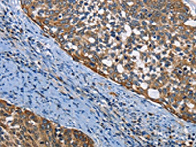 The image on the left is immunohistochemistry of paraffin-embedded Human cervical cancer tissue using CSB-PA905158(PGK1 Antibody) at dilution 1/50, on the right is treated with fusion protein. (Original magnification: ×200)