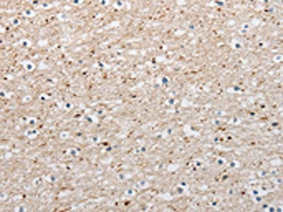 The image on the left is immunohistochemistry of paraffin-embedded Human brain tissue using CSB-PA905307(ARHGAP1 Antibody) at dilution 1/25, on the right is treated with fusion protein. (Original magnification: ×200)