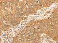 The image on the left is immunohistochemistry of paraffin-embedded Human breast cancer tissue using CSB-PA905442(MAPK7 Antibody) at dilution 1/35, on the right is treated with fusion protein. (Original magnification: ×200)