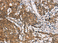 The image on the left is immunohistochemistry of paraffin-embedded Human gastic cancer tissue using CSB-PA905465(COL7A1 Antibody) at dilution 1/25, on the right is treated with synthetic peptide. (Original magnification: ×200)