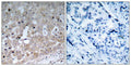 Immunohistochemical analysis of paraffin-embedded human breast carcinoma tissue using VEGFR2(Ab-1175) Antibody(left) or the same antibody preincubated with blocking peptide(right).