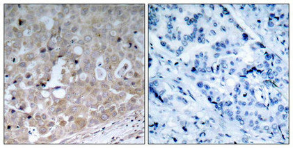 Immunohistochemical analysis of paraffin-embedded human breast carcinoma tissue using VEGFR2(Ab-1175) Antibody(left) or the same antibody preincubated with blocking peptide(right).