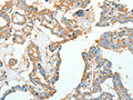 The image on the left is immunohistochemistry of paraffin-embedded Human thyroid cancer tissue using CSB-PA906019(ACTN1 Antibody) at dilution 1/10, on the right is treated with fusion protein. (Original magnification: ×200)