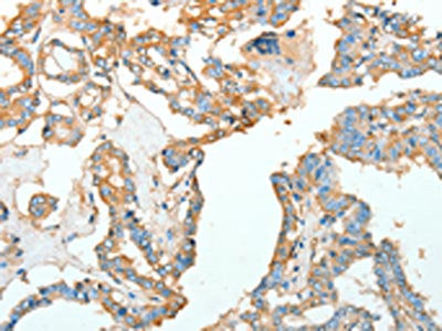 The image on the left is immunohistochemistry of paraffin-embedded Human thyroid cancer tissue using CSB-PA906019(ACTN1 Antibody) at dilution 1/10, on the right is treated with fusion protein. (Original magnification: ×200)