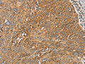 The image on the left is immunohistochemistry of paraffin-embedded Human cervical cancer tissue using CSB-PA906091(ARSK Antibody) at dilution 1/20, on the right is treated with fusion protein. (Original magnification: ×200)