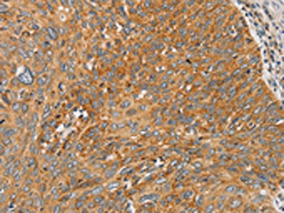 The image on the left is immunohistochemistry of paraffin-embedded Human cervical cancer tissue using CSB-PA906091(ARSK Antibody) at dilution 1/20, on the right is treated with fusion protein. (Original magnification: ×200)