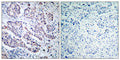 Immunohistochemical analysis of paraffin-embedded human breast carcinoma tissue using TYK2(Ab-1054) Antibody(left) or the same antibody preincubated with blocking peptide(right).